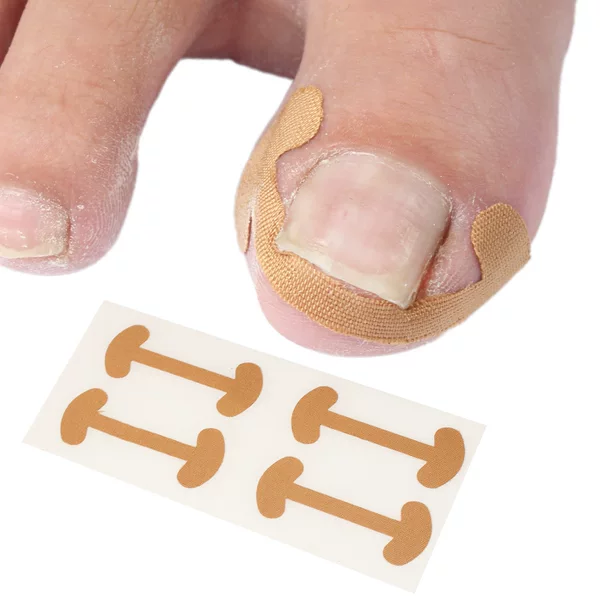 Nail groove nail patch nail correction bone foot nail nail inlay nail corrector toe nail repair deformation glue-free