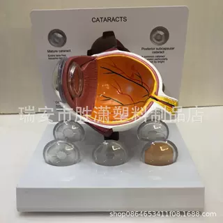供应眼球模型眼球病变模型 青光白内眼球模型 医学教学教模型