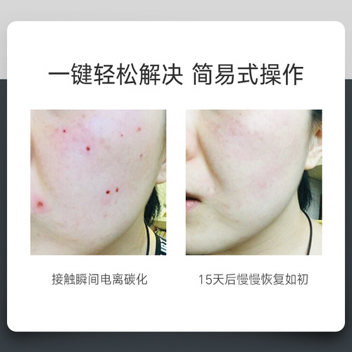 Spot removal and spot removal German small white spot nevus pen laser spot removal special beauty instrument divine spot hemorrhoids spot removal pen