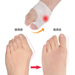 跨境大腳趾重疊分趾器大腳骨趾頭器分趾器拇趾外翻分離器