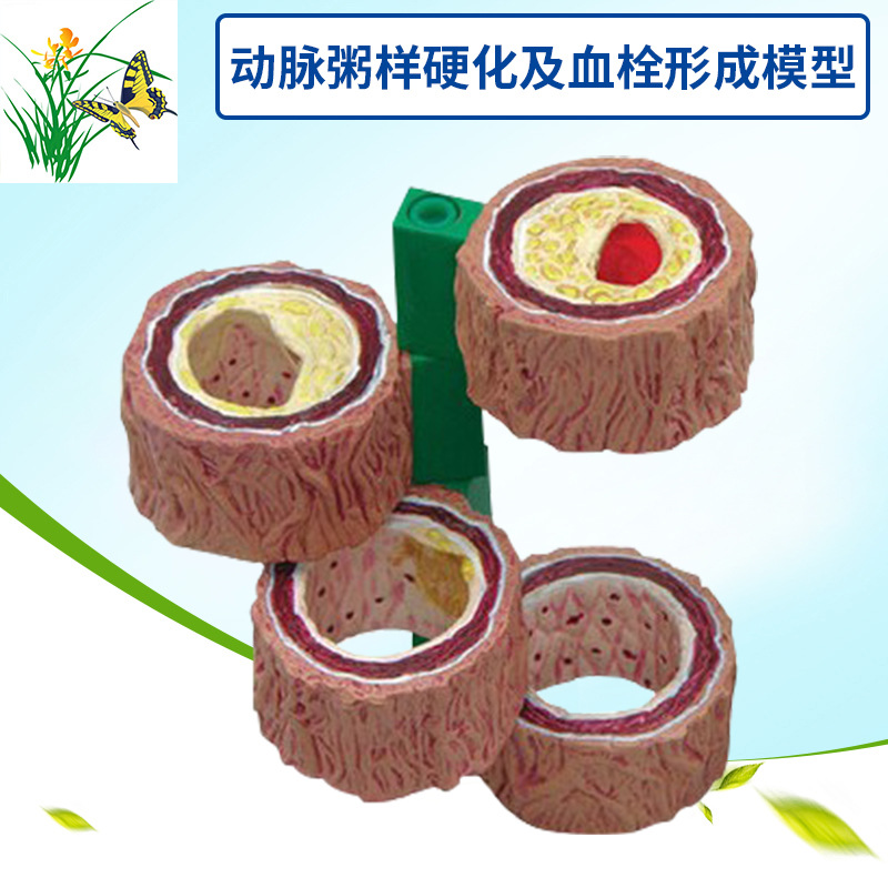 Arteria/aterosclerosis y trombosis/modelo de formación de cuatro etapas modelo de proceso vascular/endurecimiento