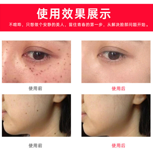 Spot scanning German novice does freckle removal, spot pen, mole removal laser, beauty instrument, special hemorrhoid spotting pen