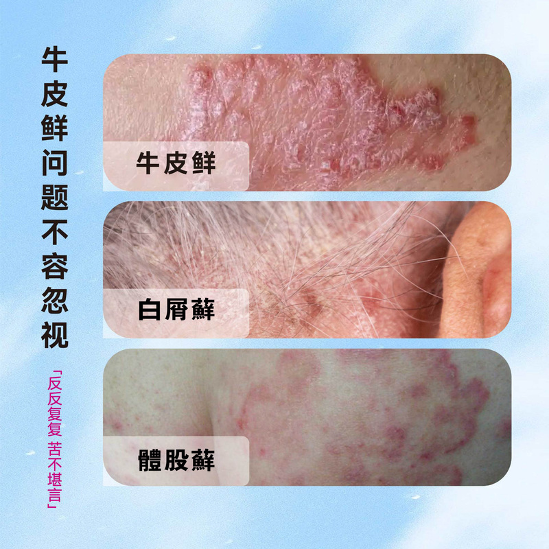 日本製牛苔王牛皮軟膏、頭皮・頭皮のフケ対策、皮膚殺菌、かゆみ止め、本物の特殊牛皮軟膏|undefined