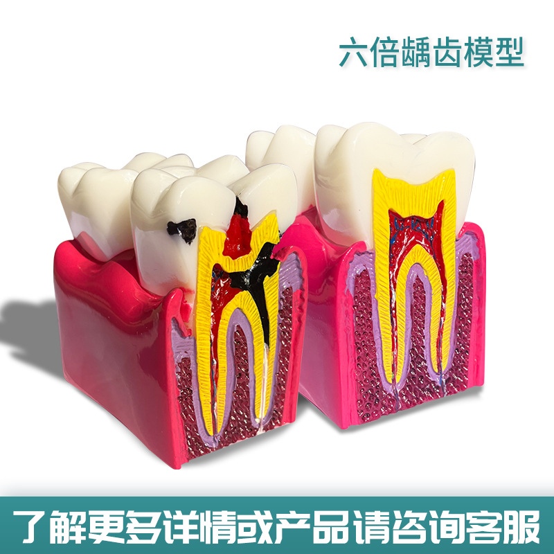 Modelo dental oral, modelo de diente nervado removible implantable, restauración, patología de boca completa, modelo de comunicación médico-paciente