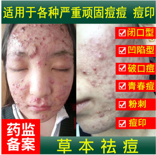 Herbal Anti-Acne Cream, Powerful Anti-Acne Cream to Remove Acne, Close Mouth, Fade Acne Marks and Pits, Acne, Student Hospital Line Exclusive Supply