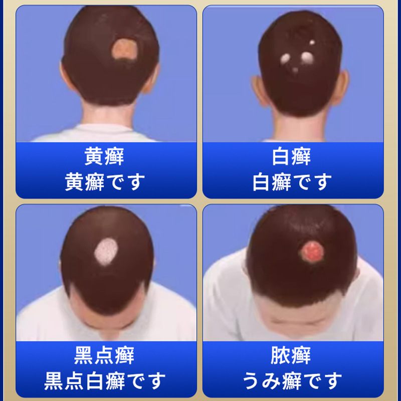 藤健郎先生の頭皮白癬専用の抗菌スプレーのかゆみ止めスプレーの毛包 _ は赤いしこりがあります。|undefined