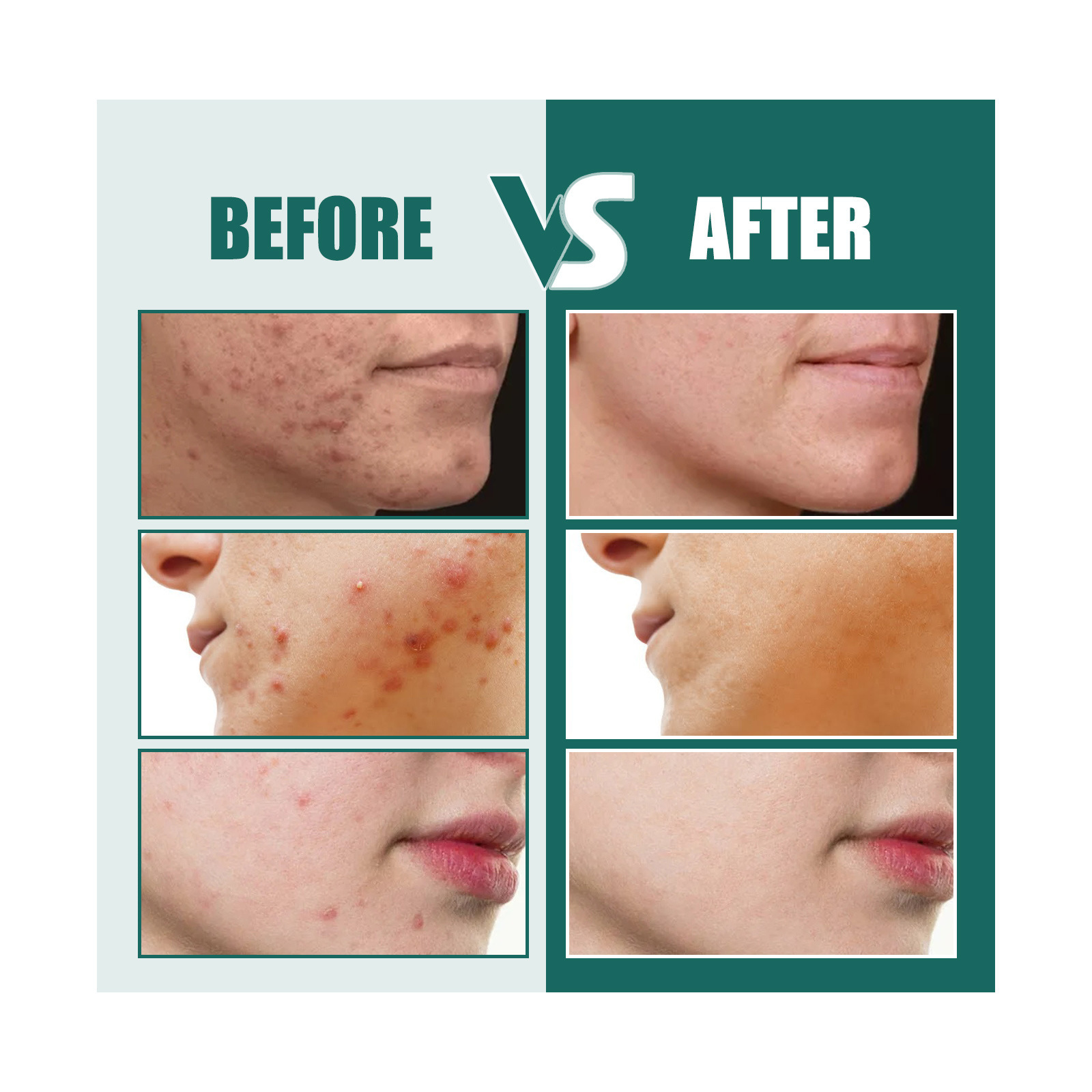 Star shaped patch for lightening spots, marks, cleaning, closing, covering, and repairing acne patches_voghion.com