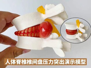 Rubber lumbar disc extrusion model prominent spine spine human skeleton bone setting massage demonstration teaching medical