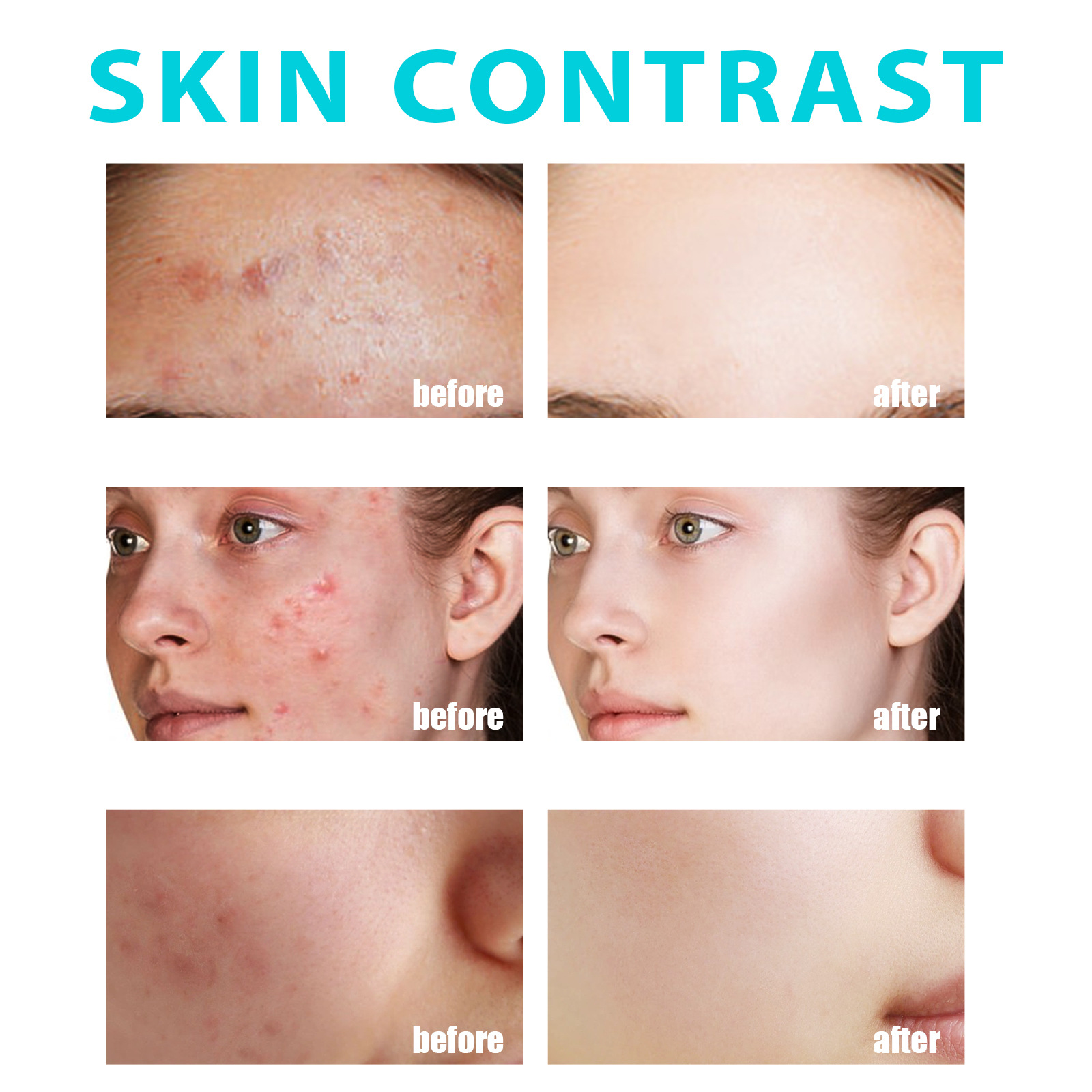 Crema antibrillante Jaysuing para reducir el acné, reducir los poros, hidratar y nutrir la piel,_voghion.com