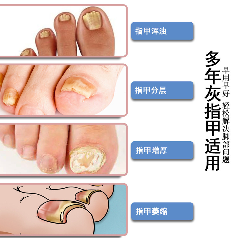 樱椿焓灰指甲 厂家批发手足指甲增厚软甲亮甲灰甲液舒甲液护理液|undefined
