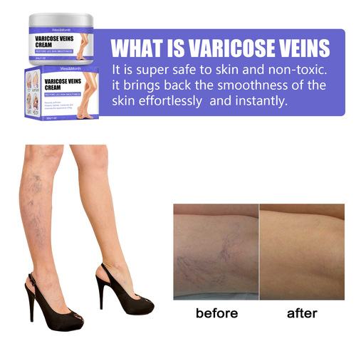 Vein repair cream, leg varicose veins, bulging leg veins, pain, Maikang leg care vein cream