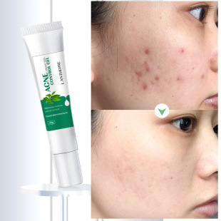 Cross-Border Spot Lianbiquan Planthome Acne Gel 20g Moisturizing Facial Care Manufacturer Wholesale
