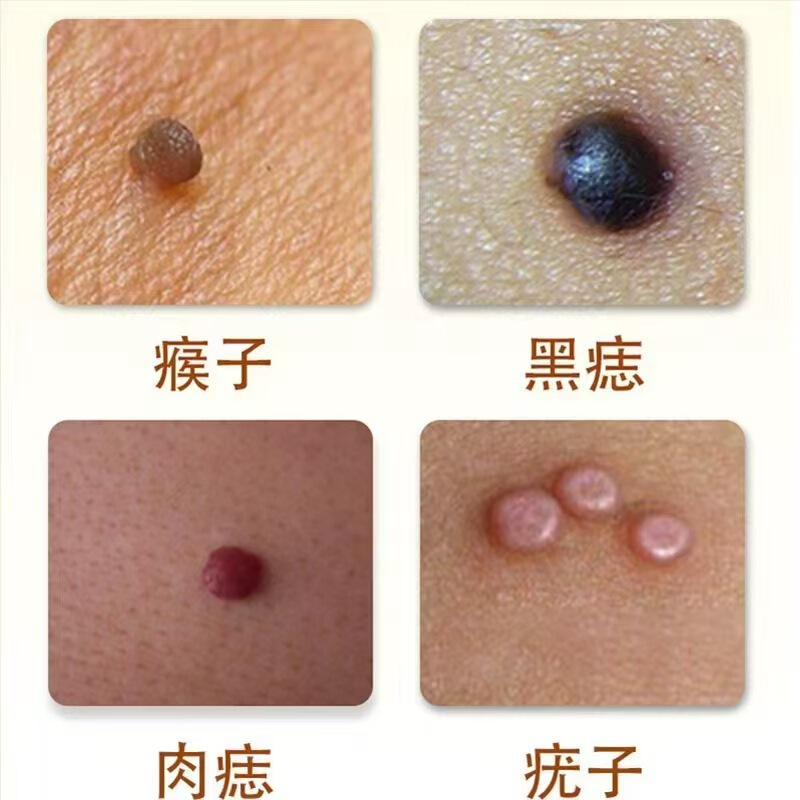 点痣膏全身可用去痣黑痣肉刺面部当场消痣无痕尤痦子瘊子脂肪粒美|undefined