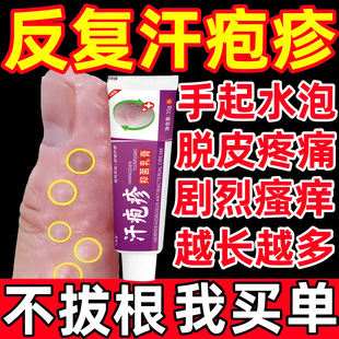 手上起小水泡专用药疱汗状疹专用软膏脱皮止痒真汉状菌感染手气膏-阿里巴巴