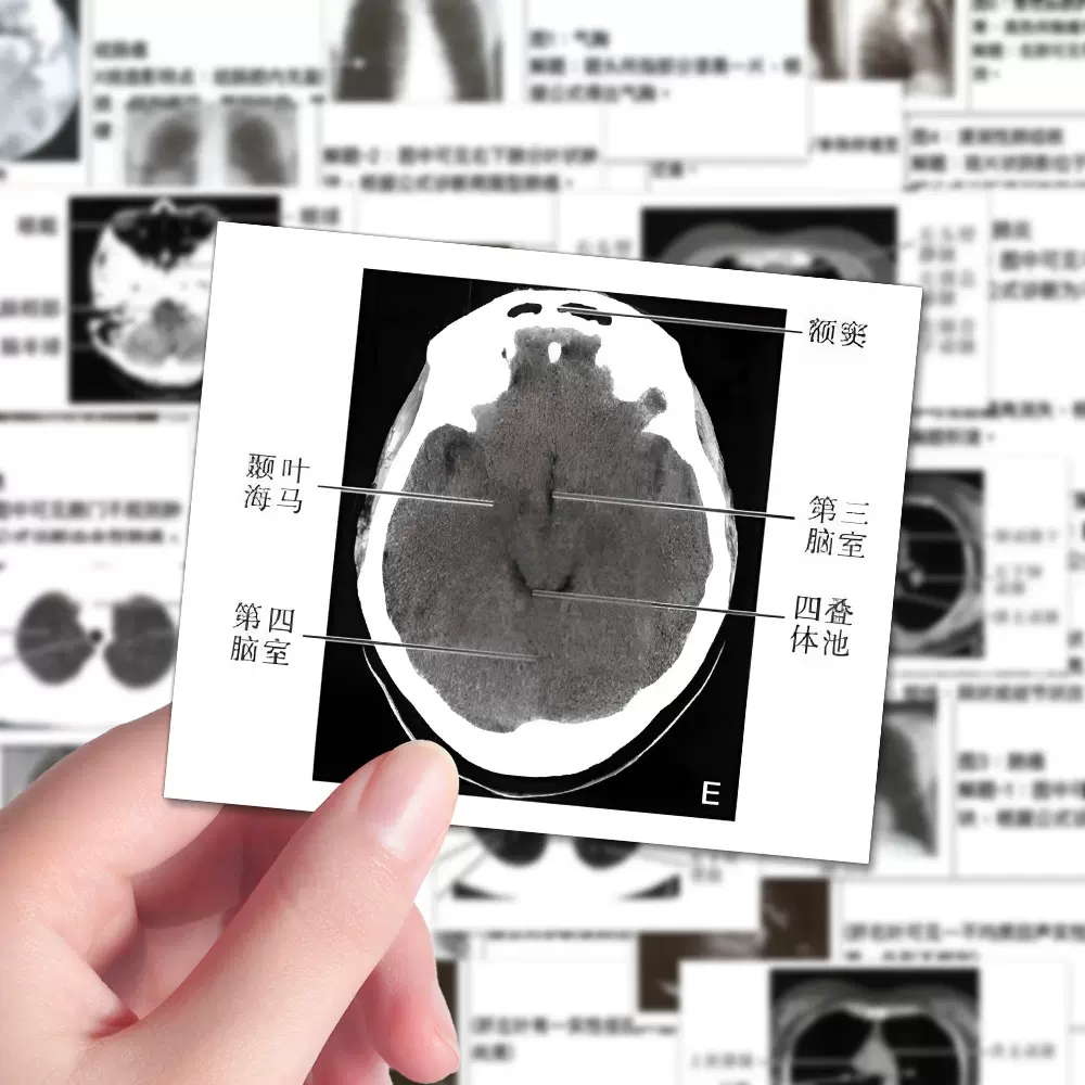 96张医学影像分析贴纸CT图解医学生知识重点干货笔记本自粘贴纸