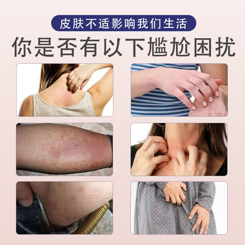 雲南百草軟膏ハーブクリーム皮膚のかゆみ断続性かゆみ王蚊刺され雲南真菌王卸売スキンケア|undefined