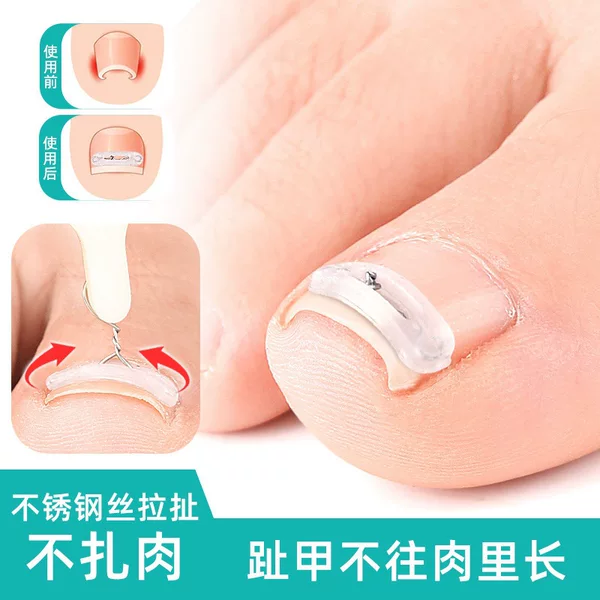 Ingrown toenail correction tape aids in physical stretching of the nail bed, is small and discreet, allows for wearing shoes and walking, and comes in various sizes