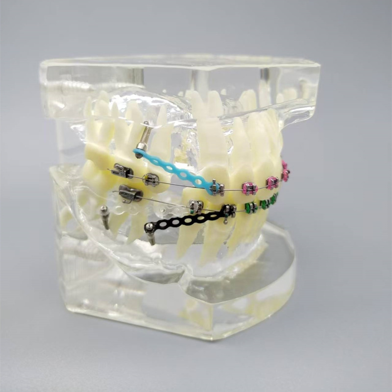 Ph3005 Dental Orthodontic Model Transparent Dental Model for Aligning Teeth and Orthodontic Correction Practice Display Model Ph3005 Dental Orthodontic Model Transparent Dental Model for Aligning Teeth and Orthodontic Correction Practice Display Model