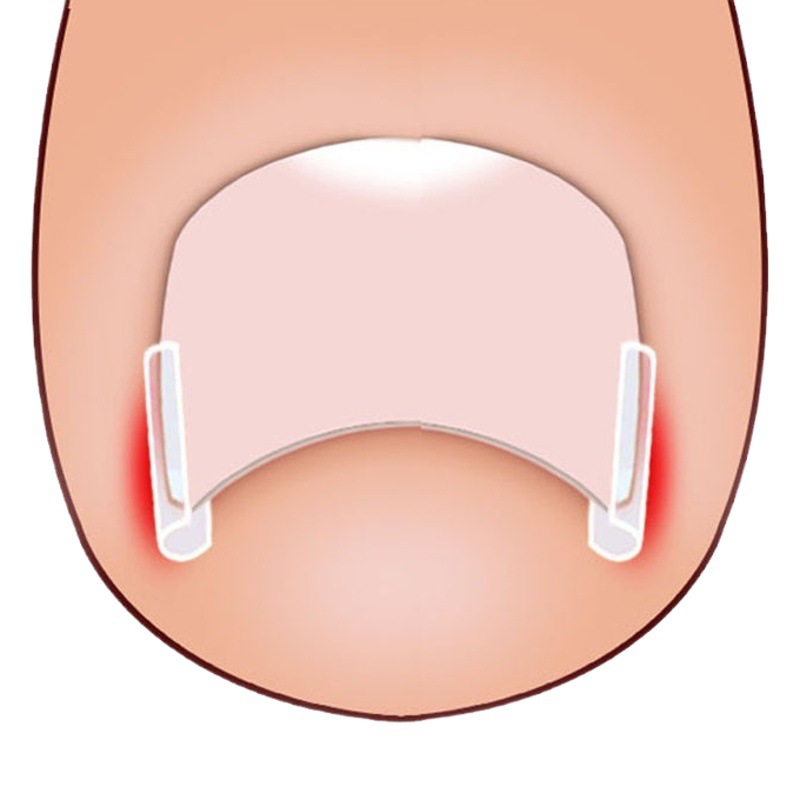 Nail Pad Nail Groove Inlay Nail Corrector Nail Pad Roll Nail Corrector Pull and Stick Toenail Long into Meat
