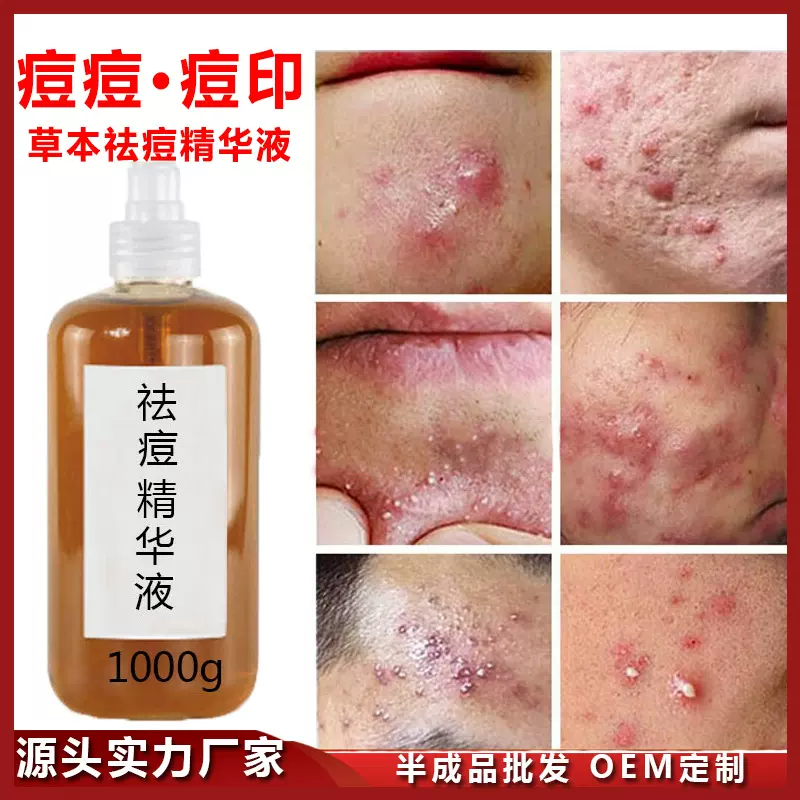 草本祛痘精华液去痘印修护粉刺闭口收缩毛孔祛痘精华液祛痘水批发
