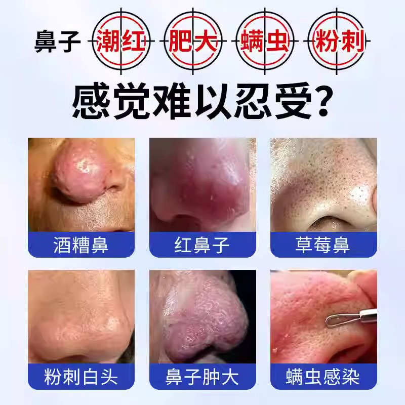 岩井昃弘酒糟鼻草莓鼻去红鼻子黑头收缩毛孔专用修护鼻头红血丝膏|undefined
