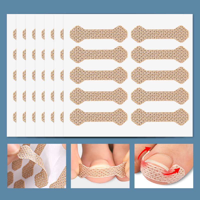 Inlay nail nail nail sticking foot nail into the meat long toe pad nail repair pull patch orthopedic appliance