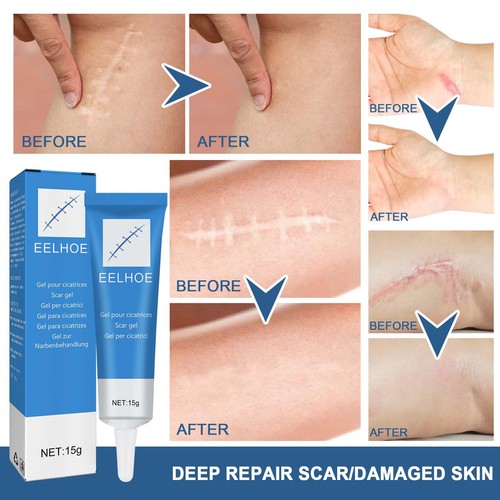 EELHOE Scar Repair Gel External Cold Compress Cream Skin Damage Repair Type Softens, Smoothes and Moisturizes Scars