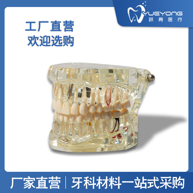 Modelo de implante dental, modelo dental patológico, modelo oral desmontable, modelo de explicación de puente, protección dental