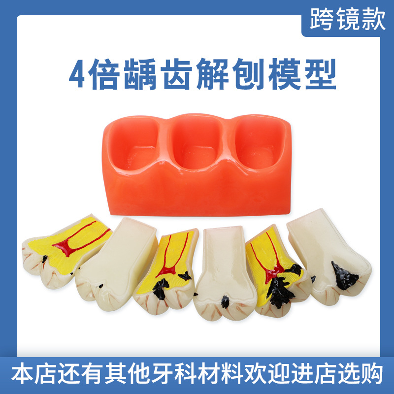 Descomposición de caries dental modelo anatomía modelo dientes cuidado dental caries dental
