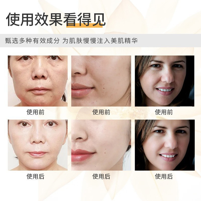 微結晶ほうれい線パッチ卸売リフティング、引き締め、小じわの軽減リフティングマスククロスボーダーハイドロゲルほうれい線パッチ|undefined