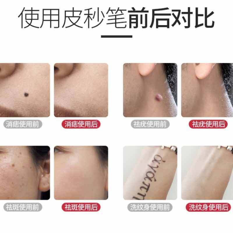 ピコ秒はシミを取り除きます。家庭用レーザーは速くタトゥーを洗います。|undefined