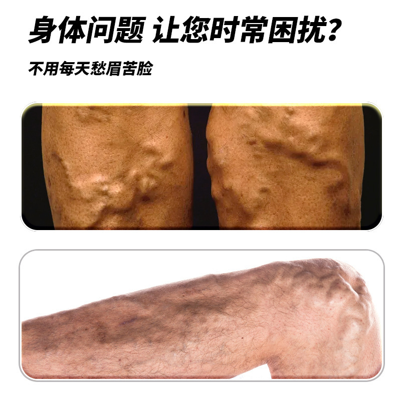 香港大药房静脉舒膏滋润膏静脉扩展迂曲膏皮肤血管隆起膏批发代发|undefined