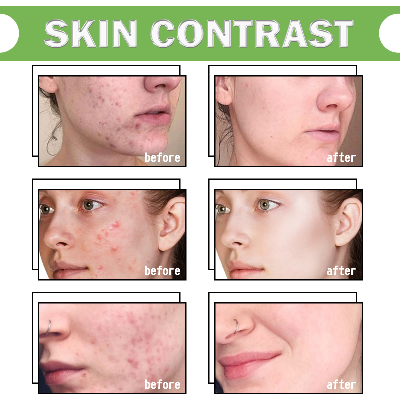 EELHOE Gel detergente all'aloe Schiarisce Chiude la bocca Acne, Migliora la pelle acneica, Idrata Cura della pelle_voghion.com