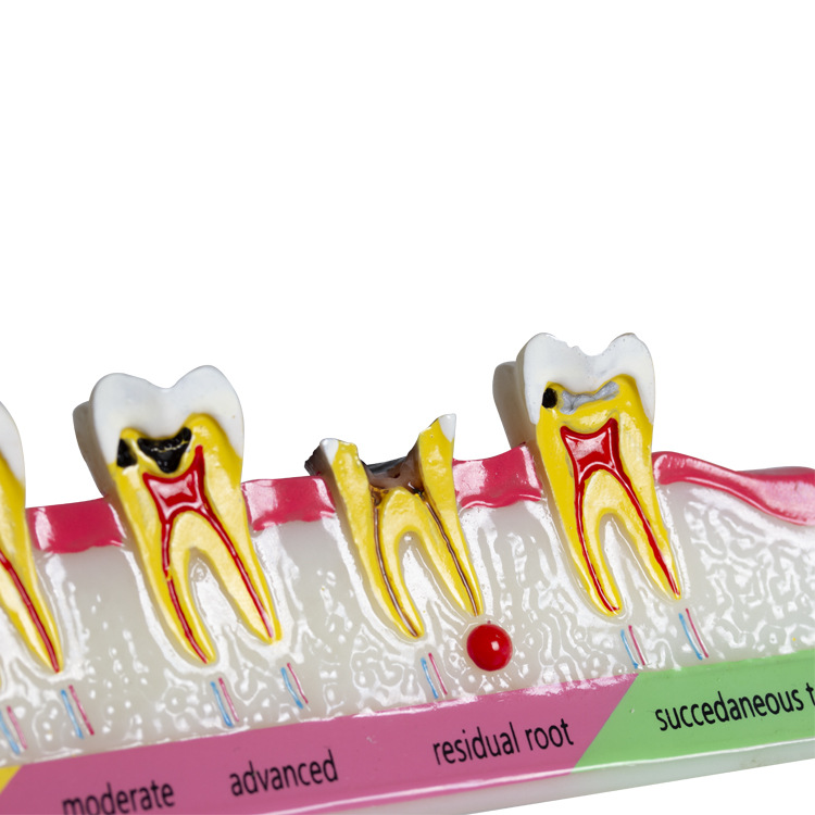 Modelo de clasificación de caries dental Demostración de la evolución de la caries dental Explicación de la comunicación médico-paciente Modelo de enseñanza dental oral
