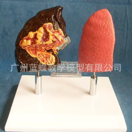 肺模型 肺结构模具 吸烟危害健康吸烟肺呼吸系统 病理肺解剖模型