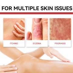 South Moon 牛皮蘚護理霜 修護手足蘚緩解皮膚瘙癢發紅脫皮護理霜