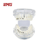 UM-B21MC水晶正畸矫正模型金属陶瓷牙托牙套牙模型