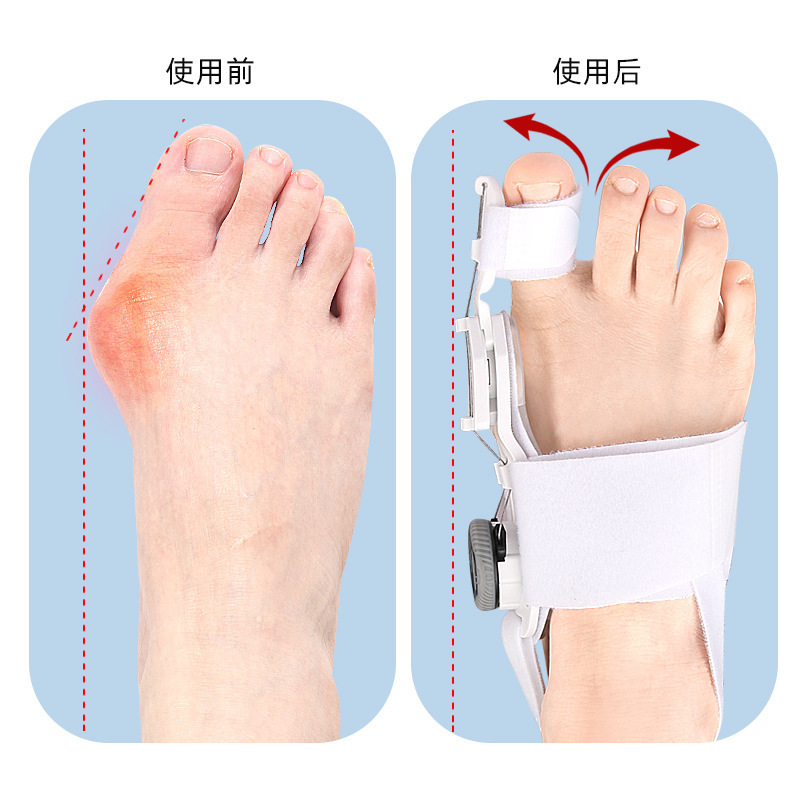 親指の外転矯正器の大きな足の骨が突出しています。|undefined