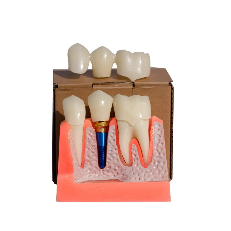 Dental 4 veces modelo de implante dentadura reparación implante interpretación puente desmontable corona modelo de implante