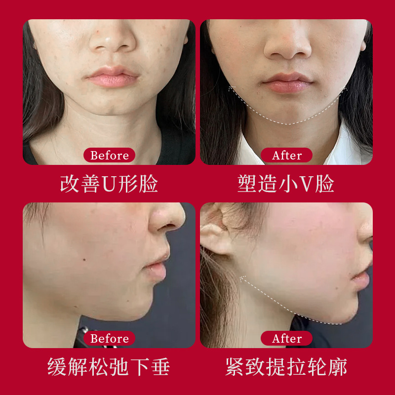 [Tik Tok Hot Style] レッドハニーレッド包帯 V フェイス二重あご耳吊りリフティングと引き締めオリジナル若返りマスク卸売配送|undefined