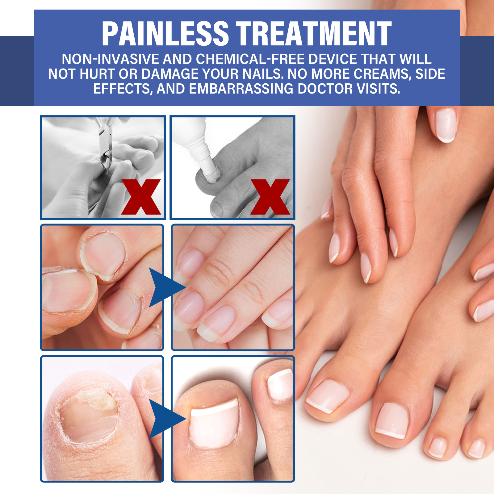 EELHOE repair LED phototherapy instrument for hand foot nails yellowing, soft repair, thickening, and smoothing of the_voghion.com