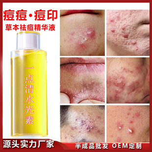 Herbal Anti-Acne Essence to Remove Acne Marks, Acne Pits, Acne Closed Mouth, Shrink Pores, Anti-Acne Essence, Anti-Acne Water Wholesale