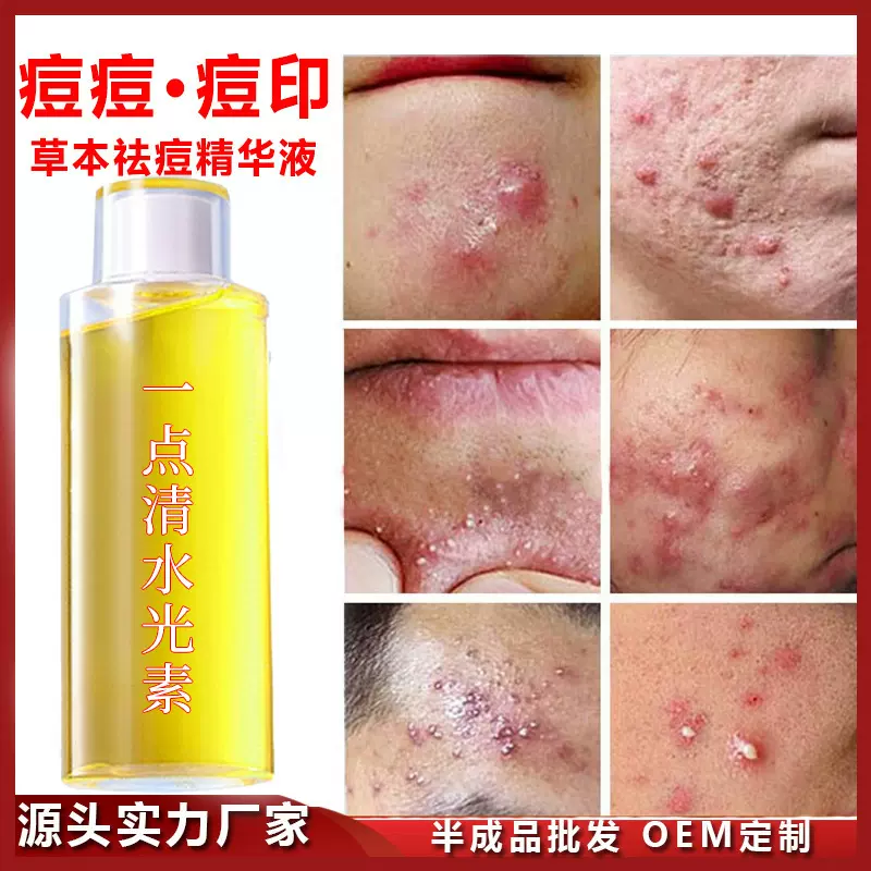 草本祛痘精华液去痘印痘坑粉刺闭口收缩毛孔祛痘精华液祛痘水批发