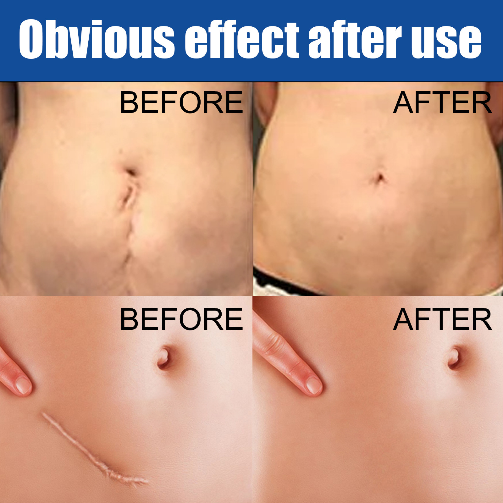 eelhoe skin repair cream scar cream care burns burns prints acne marks fade smoothing care cream scar cream,(Pack of 3)_voghion.com