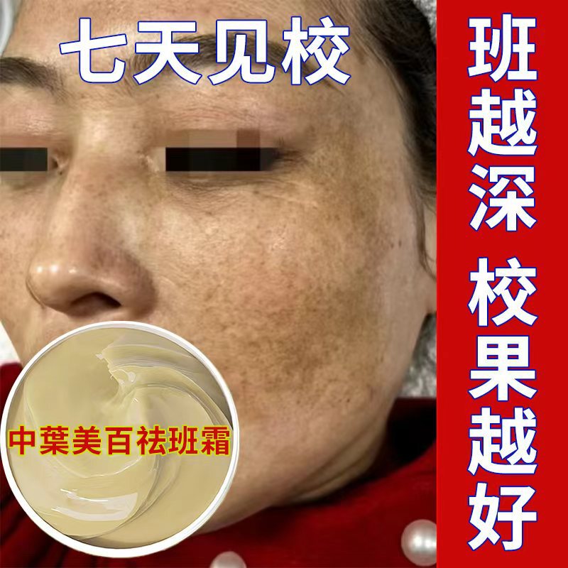 Herbal Freckle Cream, Rejuvenating Skin, Whitening, Removing Melanin, Lightening Freckles, Chloasma, Sun Spots, Beauty Salon Exclusive