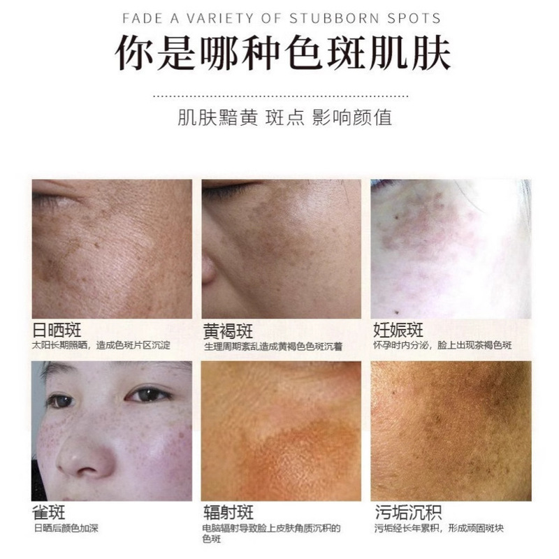 美容室は、肝斑、シミ、鉛・水銀斑、メラニン電球、美白・そばかす除去キット専用の美白キットを提供しています。|undefined