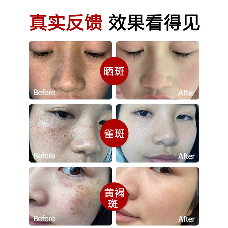 アルブチン原液、明るく、ダークイエローを改善、肌を明るく、美白、肝斑を軽減、スポット溶解エッセンス、病院卸売|undefined