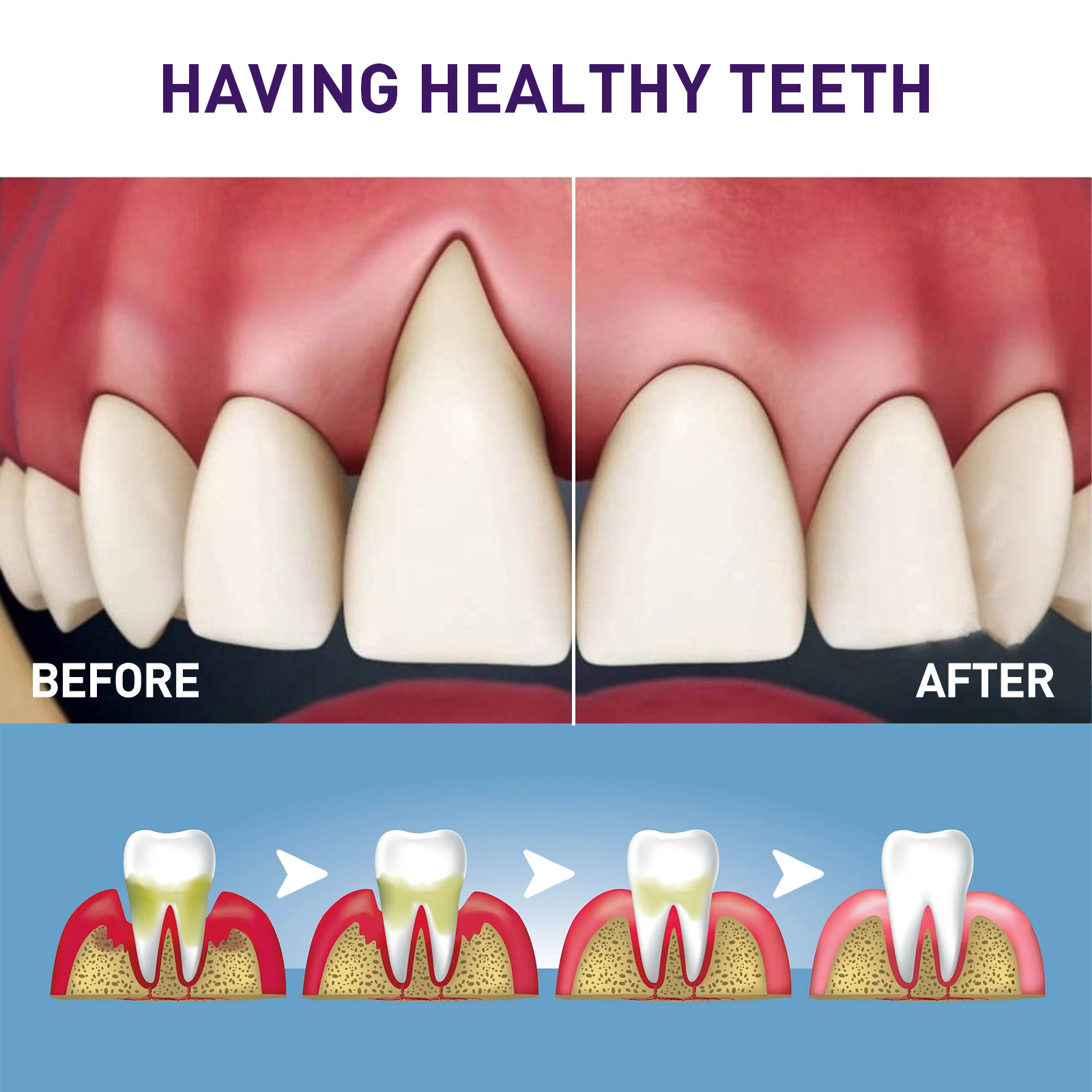 West&Month Dental Liquid Pen zur Reinigung von Verfärbungen, gelben Zähnen, Aufhellung, Aufhellung und Zahnfleischentfernung_voghion.com
