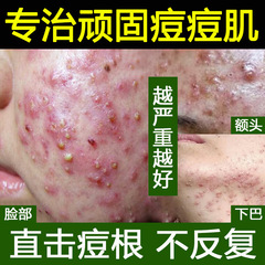 ニキビ跡を薄くするハーブニキビ治療エッセンス、ニキビ閉鎖ニキビ、毛穴縮小、美容室サリチル酸ニキビ治療水