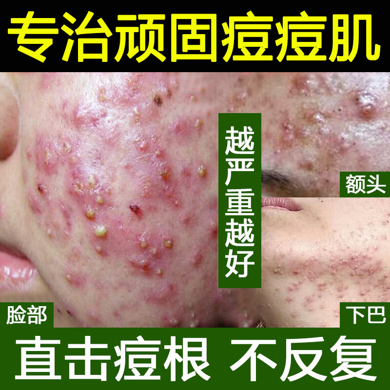 ニキビ跡を薄くするハーブニキビ治療エッセンス、ニキビ閉鎖ニキビ、毛穴縮小、美容室サリチル酸ニキビ治療水|undefined